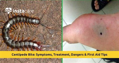 Sting Of Centipede