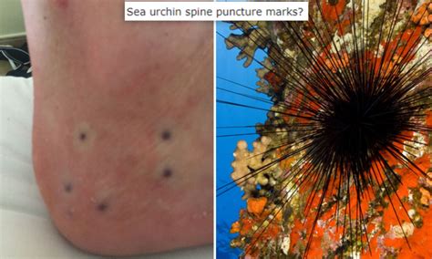 Sting Of Sea Urchin