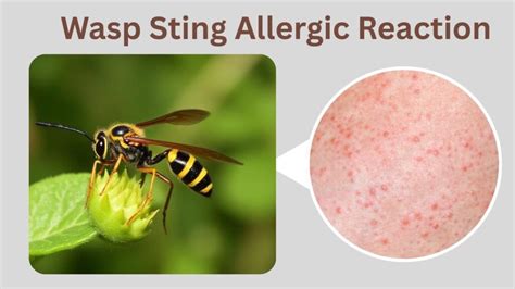 Sting Of Wasp Meaning