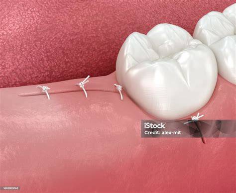 Stitched Wisdom Tooth