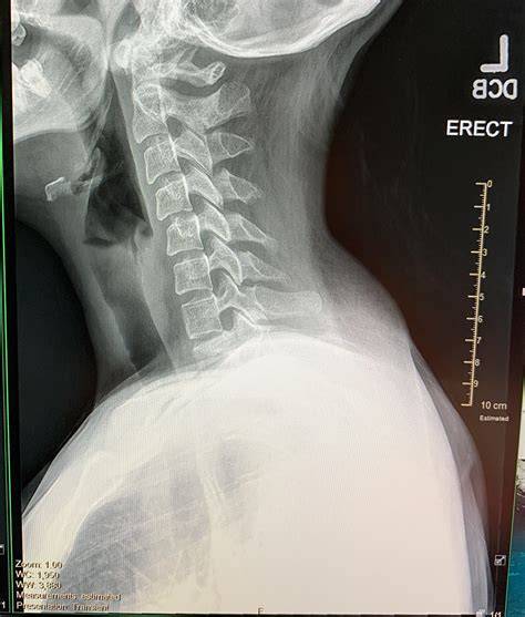 Straightening Of Cervical Vertebrae