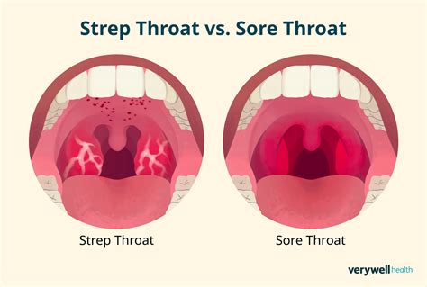 Strep Throat And Sore Ears