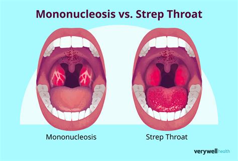 Strep Throat Español