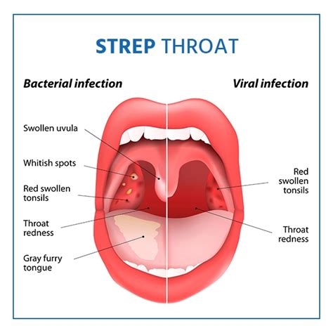 Strep Throat In Infants Signs