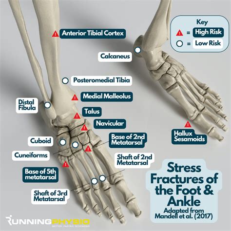Stress Fracture Symptoms