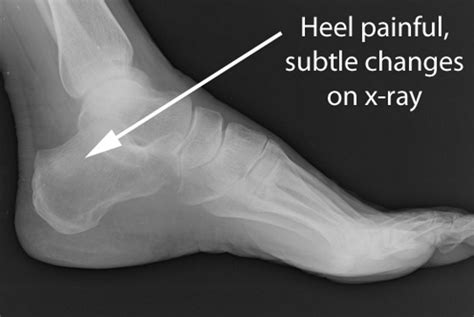 Stress Fx Foot
