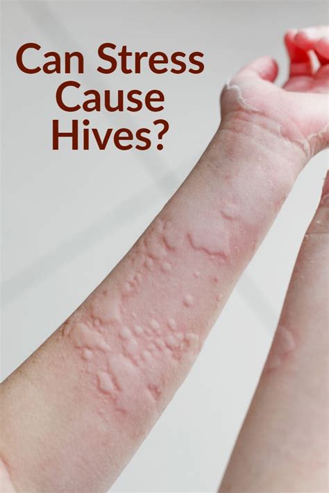 Stress Symptoms Hives