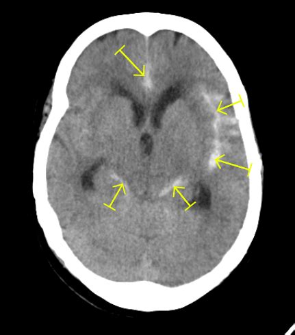 Subarachnoid Hemorrhage Ct
