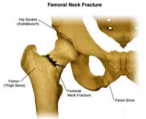 Subcapital Femoral Neck Fracture