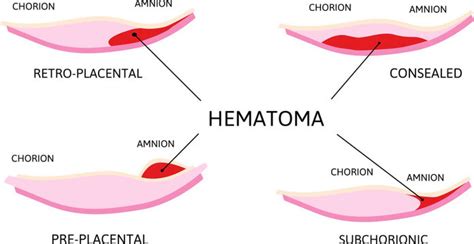 Subchorionic Hematoma Bleeding