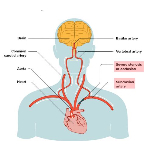 Subclavian Artery Stenosis