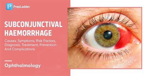 Subconjunctival Hemorrhage Supportive Therapy