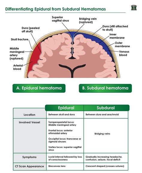 Subdural Vs Epidural Haematoma