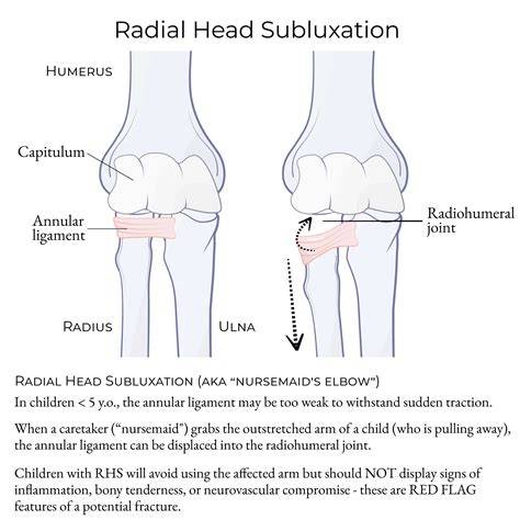 Subluxation Of Radius