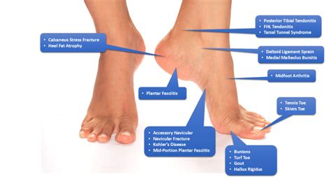 Sudden Foot Pain Without Injury