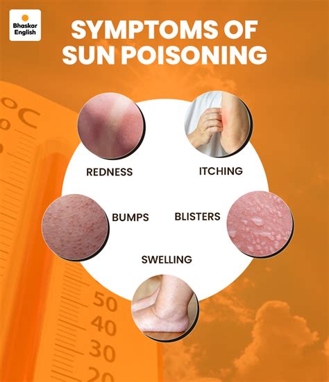 Sun Poisoning Sun Rash