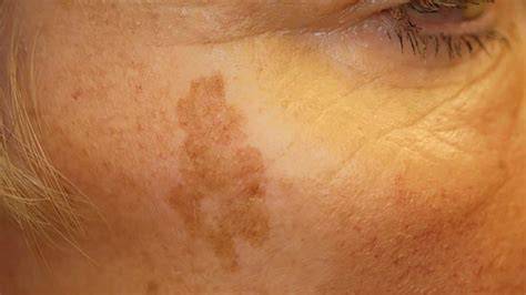 Sunspots On Face