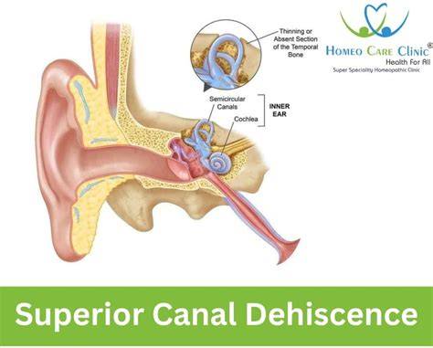 Superior Canal Dehiscence Syndrome