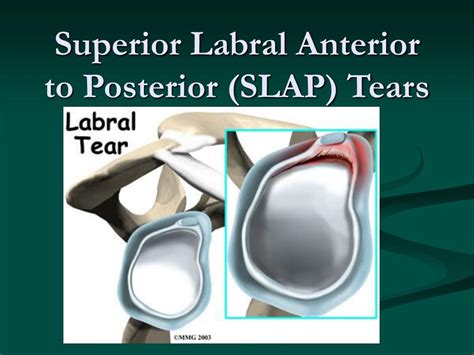 Superior Labral Anterior Posterior