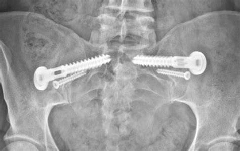 Surgery For Sacroiliac