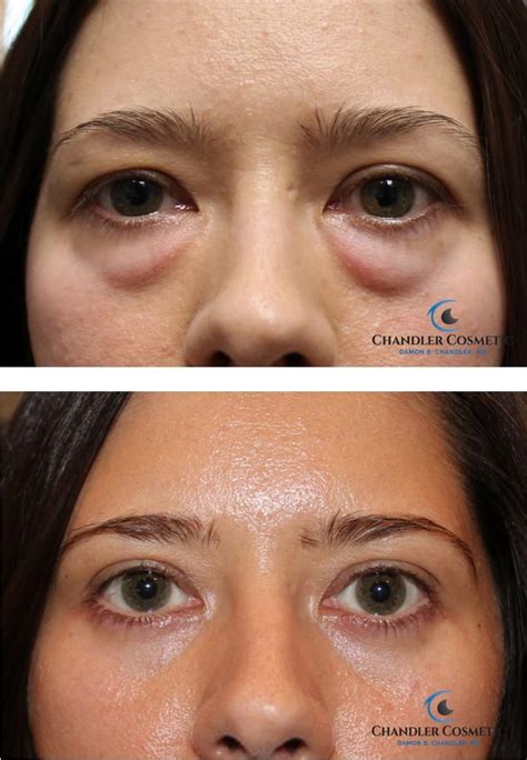 Surgical Eye Bag Removal