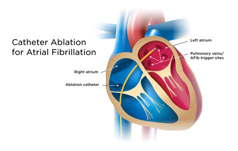 Svt Tachycardia Ablation