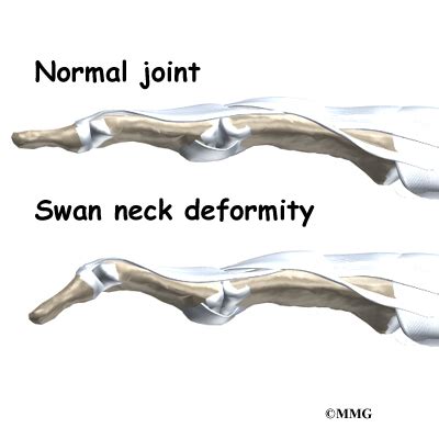 Swan Neck Deformity Finger