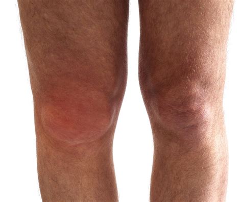 Swelling Above Knee
