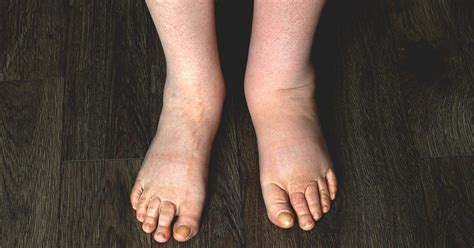 Swelling In One Foot