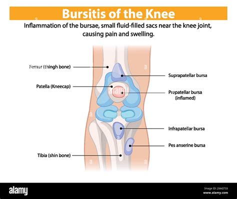 Swelling In Patella