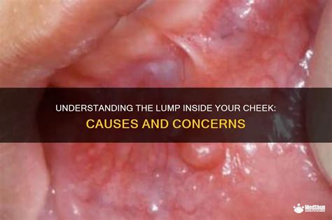 Swelling Inside Cheek