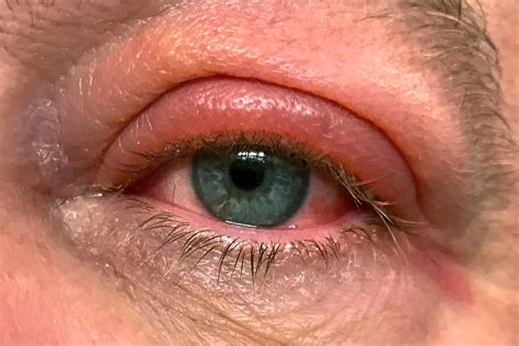 Swollen Eyelid Causes