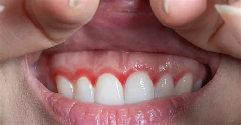 Swollen Gums After Flossing