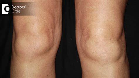 Swollen Knee No Pain
