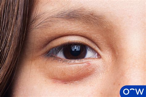 Swollen Under Eye