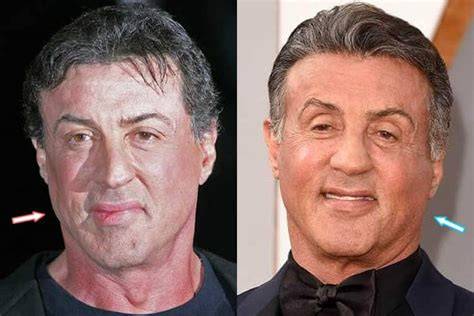 Sylvester Stallone Plastic Surgery Face