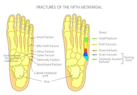 Symptoms Of A Fractured Foot