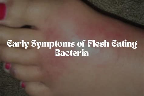 Symptoms Of Bacteria Eating Flesh