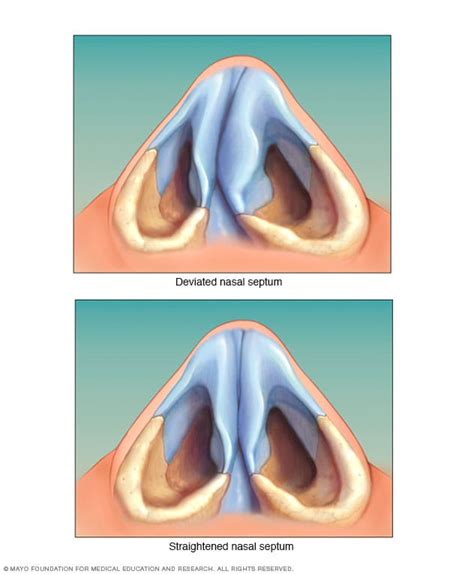 Symptoms Of Deviated Septum