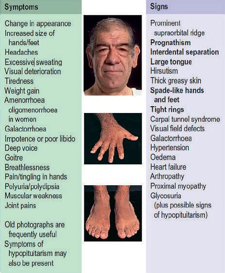 Symptoms Of Gigantism