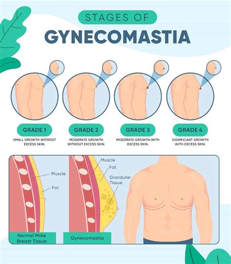 Symptoms Of Gynecomastia