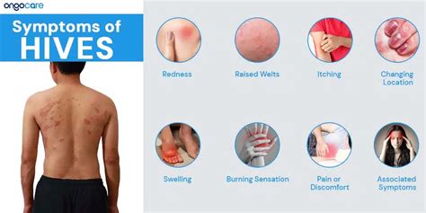 Symptoms Of Hives