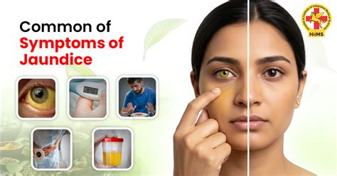Symptoms Of Jaundice In Tamil