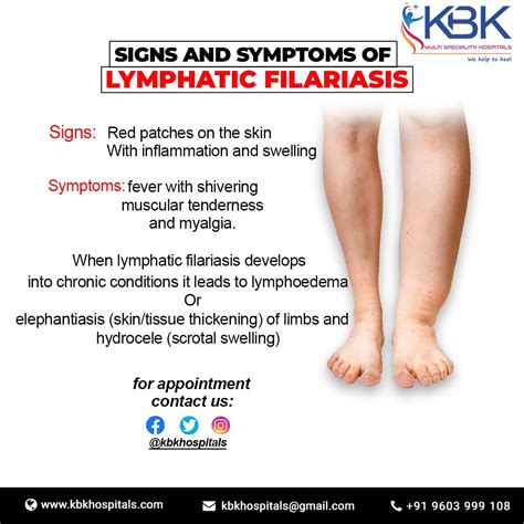 Symptoms Of Lymphatic Filariasis