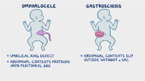 Symptoms Of Omphalocele