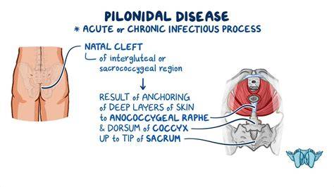 Symptoms Of Pilonidal Abscess