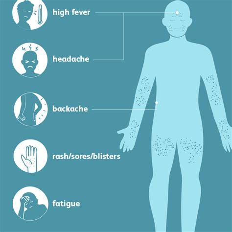 Symptoms Of Smallpox