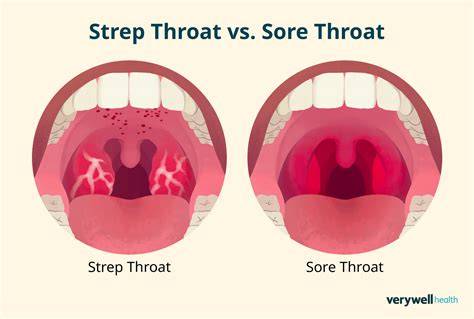 Symptoms Of Sore Throat
