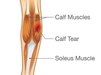 Symptoms Of Torn Calf