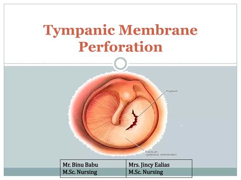 Symptoms Of Tympanic Membrane Perforation